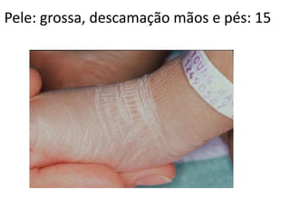 Pele: grossa, descamação mãos e pés: 15
 
