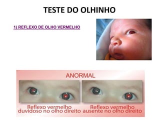 TESTE DO OLHINHO
1) REFLEXO DE OLHO VERMELHO
 