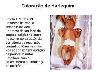 Coloração de Harlequim
• - afeta 15% dos RN
- aparece na 2ª e 3ª
semanas de vida
- eritema de um lado do
corpo e palidez no outro
- decorrente da ausência
transitória da regulação
central do tônus vascular
- os episódios tem duração
de poucos minutos
- melhora com o
aquecimento ou mudança
de posição
 