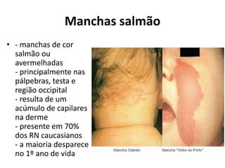 Manchas salmão
• - manchas de cor
salmão ou
avermelhadas
- principalmente nas
pálpebras, testa e
região occipital
- resulta de um
acúmulo de capilares
na derme
- presente em 70%
dos RN caucasianos
- a maioria desparece
no 1º ano de vida
 