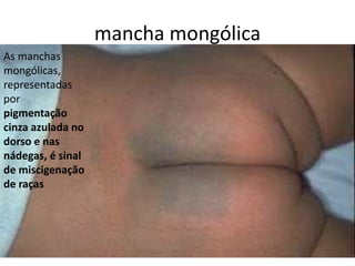 mancha mongólica
As manchas
mongólicas,
representadas
por
pigmentação
cinza azulada no
dorso e nas
nádegas, é sinal
de miscigenação
de raças
 