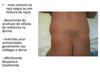 • - mais comum na
raça negra ou em
mistura de raças
- decorrente do
acúmulo de células
de melanina na
derme
- manchas azul-
acinzentadas
geralmente nas
nádegas e dorso
- dificilmente
desparece
totalmente
 