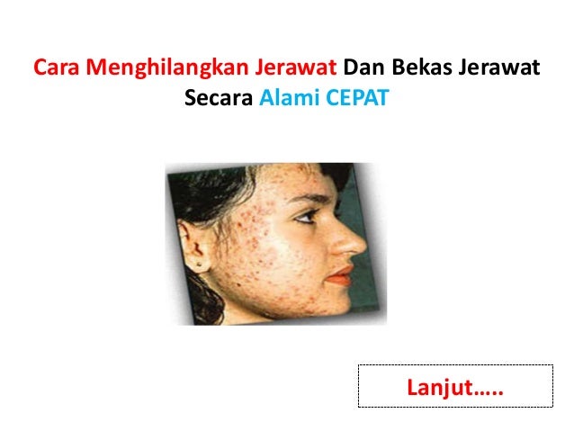 Cara Menghilangkan Jerawat dan Bekas Jerawat Secara Alami Dengan Cepat