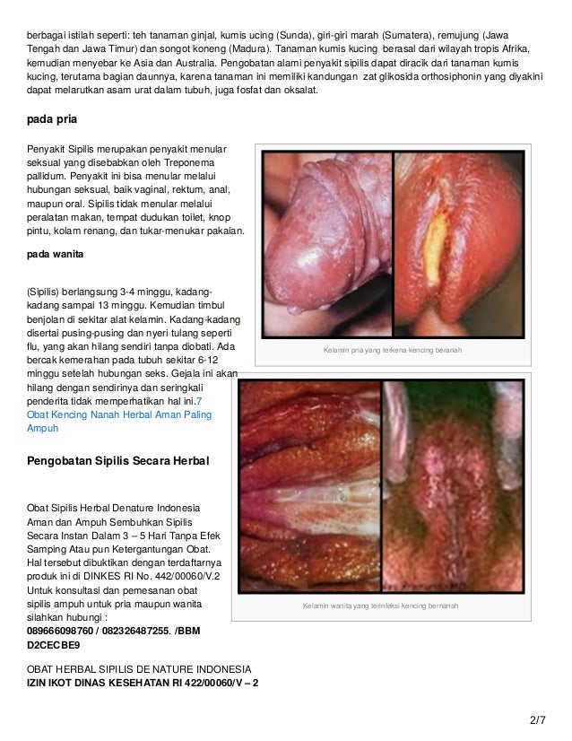  Cara mengobati raja singa sipilis 