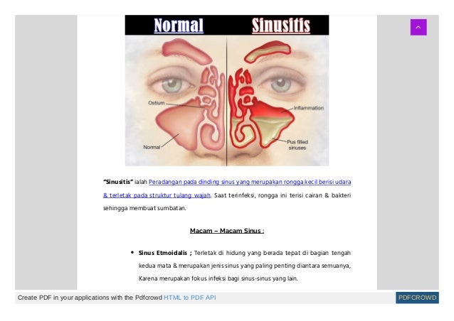 Cuál es el mejor medicamento para la sinusitis