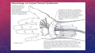 Median Nerve Injury and Carpal Tunnel Syndrome 