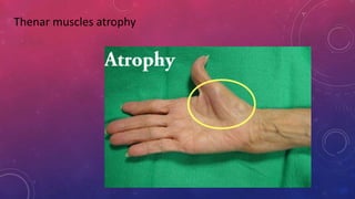 Thenar muscles atrophy
 