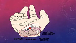 Median Nerve Injury and Carpal Tunnel Syndrome 