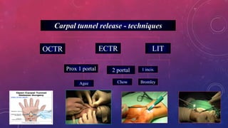 OCTR ECTR LIT
Prox 1 portal 2 portal
Agee Chow Bromley
1 incis.
Carpal tunnel release - techniques
 