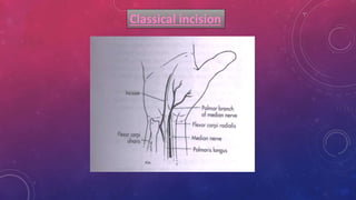 Classical incision
 