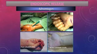 ENDOSCOPIC RELEASE
Advantages
Small incision
Single
suture
Fast rehabilitation Better cosmetic result
 