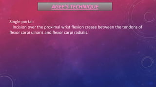 AGEE’S TECHNIQUE
Single portal:
Incision over the proximal wrist flexion crease between the tendons of
flexor carpi ulnaris and flexor carpi radialis.
 