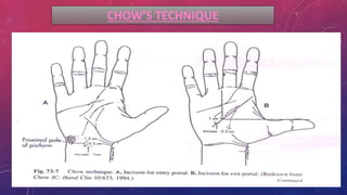 CHOW’S TECHNIQUE
 