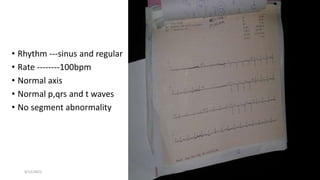 9/12/2022
• Rhythm ---sinus and regular
• Rate --------100bpm
• Normal axis
• Normal p,qrs and t waves
• No segment abnormality
 