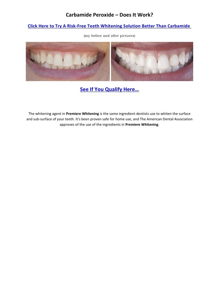 Carbamide Peroxide Whitening