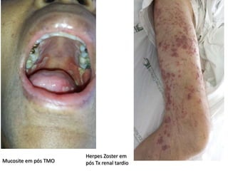 Mucosite em pós TMO
Herpes Zoster em
pós Tx renal tardio
 