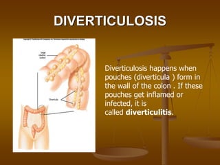 DIVERTICULOSIS
Diverticulosis happens when
pouches (diverticula ) form in
the wall of the colon . If these
pouches get inf...