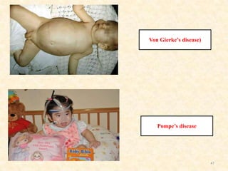 Von Gierke’s disease)

Pompe’s disease

47

 