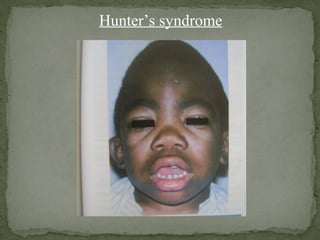 Hunter’s syndrome
 