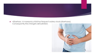  •Diarrhea : A marasmicchildhas frequent watery stools (diarrhoea).
Consequently,the childgets dehydrated.
 
