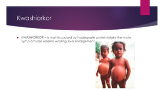 Kwashiorkor
 KWASHIORKOR = is mainly caused by inadequate protein intake the main
symptoms are edema wasting, liver enlargement
 