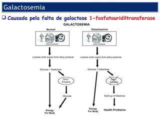  Causada pela falta de galactose 1-fosfatouridiltransferase
 