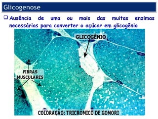  Ausência de uma ou mais das muitas enzimas
  necessárias para converter o açúcar em glicogênio
 