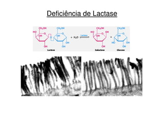Deficiência de Lactase
 