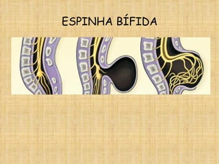 ESPINHA BÍFIDA 