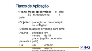 • Plano Meso-epidérmico:
Só introduzido na
pele.
o bizel
é
• Objetivo: produção e remodelação
do colágeno
- O bizel da agulha é voltado para cima
- Agulha angulada em
menos de 45
graus (agulha pode estar
paralela a pele)
- Há um eritema
intenso, ocorre
PlanosdeAplicação
 