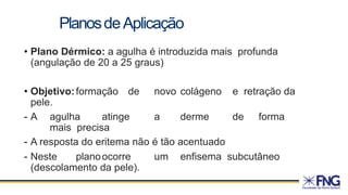 • Plano Dérmico: a agulha é introduzida mais profunda
(angulação de 20 a 25 graus)
• Objetivo:formação de novo colágeno e retração da
pele.
- A agulha atinge a derme de forma
mais precisa
- A resposta do eritema não é tão acentuado
- Neste planoocorre um enfisema subcutâneo
(descolamento da pele).
PlanosdeAplicação
 