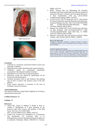 International Journal of Surgery Science http://www.surgeryscience.com
~ 40 ~
Fig 4: Healing ulcer
Fig 5: After split thickness skin grafting.
Conclusion
1. Carbuncle is a commonly encountered infective lesion seen
especially in diabetics.
2. Rapid glycaemic control should precede surgical treatment.
3. Antibiotics should be commenced immediately
accompanied with adequate hydration of patient.
4. Debridement is the main stay of surgical treatment.
5. Meticulous wound care should be administered till the
lesion enters the healing phase.
6. Ancillary procedures such as split thickness skin grafting
may be done in patient with extensive areas of the skin
affected.
7. Proper patient education is necessary at the time of
discharge to prevent recurrence.
Acknowledgements
The authors would like to thank Parth Vagholkar for his help in
typesetting the manuscript.
Conflict of interest: Nil
Funding: Nil
References
1. Akram MU, Atique H, Siddiqui S, Haider S, Raza A,
Arshad N. Management of a giant carbuncle on the
posterior trunk with excision and grafting. J Pak Med
Assoc. 2021 Nov;71(11):2665-2668.
DOI: 10.47391/JPMA.011651. PMID: 34783757.
2. Izmaĭlov SG, Izmaĭlov GA, Podushkina IV, Tereshchenko
VIu, Beschastnov VV, Aver'ianov MIu, et al.
Khirurgicheskoe lechenie karbunkula [Surgical treatment of
a carbuncle]. Khirurgiia (Mosk). 2003;(9):33-7. Russian.
PMID: 14533379.
3. ROST. Neueres über die Behandlung der Furunkel,
Karbunkel und Schweissdrüsenabszesse [Recent methods of
treatment of furuncle, carbuncle and sweat gland abscesses].
Z Haut Geschlechtskr. 1950 Jun 1;8(11):459-60.
Undetermined Language. PMID: 15431823.
4. Lin HS, Lin PT, Tsai YS, Wang SH, Chi CC. Interventions
for bacterial folliculitis and boils (furuncles and carbuncles).
Cochrane Database Syst Rev. 2021 Feb 26;2(2):CD013099.
DOI: 10.1002/14651858.CD013099.pub2. PMID:
33634465; PMCID: PMC8130991.
5. Marques SA, Abbade LPF. Severe bacterial skin infections.
An Bras Dermatol. 2020 Jul-Aug;95(4):407-417. DOI:
10.1016/j.abd.2020.04.003. Epub 2020 May 16. PMID:
32507327; PMCID: PMC7335880.
6. Sharma S, Verma KK. Skin and soft tissue infection. Indian
J Pediatr. 2001 Jul;68(3):S46-50. PMID: 11980459.
How to Cite This Article
Vagholkar K, Bhatnagar I, Hamdule A, Prajapat S, Narang N. Carbuncle:
A challenging infective lesion. International Journal of Surgery Science.
2023;7(1):38-40.
Creative Commons (CC) License
This is an open access journal, and articles are distributed under the terms
of the Creative Commons Attribution-NonCommercial-ShareAlike 4.0
International (CC BY-NC-SA 4.0) License, which allows others to remix,
tweak, and build upon the work non-commercially, as long as appropriate
credit is given and the new creations are licensed under the identical terms.
 