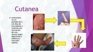 Cutanea
 evoluciona
en un
período de 2
a 6 días de
una pápula a
vesícula con
formación
de una
escara negra
deprimida e
indolora y
marcado
edema.
 