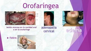 Orofaríngea
 fiebre.
lesión mucosa en la cavidad oral
o en la orofaringe
adenopatía
cervical
 