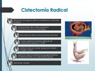 Cistectomía Radical
Remoción de órganos pélvicos anteriores en cánceres
invasivos
Conservación de la uretra permita la
reconstrucción de una neovejiga
Recurrencias dentro de los primeros tres años
Tumor uretral en hombres después de
cistectomía radical 6.1-10.6%
Uretrectomía en cáncer vesical con amplio
margen uretral
Disección pélvica bilateral de ganglios linfáticos
simultáneamente con cistectomía radical
Derivación urinaria
 