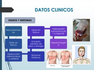 DATOS CLINICOS
Macrohematu
ria
Dolor en
flanco
Obstrucción
pélvica renal
o ureteral
Síntomas
irritativos
Anorexia,
pérdida de
peso y letargia
Masa en
flanco
Adenopatía
supraclavicula
r o inguinal
Hepatomegali
a
SIGNOS Y SINTOMAS
 