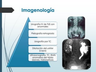 Imagenología
Urografía IV de TUS son
anormales
Pielografía retrograda
Urografía por TC
Dilatación del uréter
(copa)
Ultrasonografía, TC, RMN
anomalías del tejido
blando, hidronefrosis
 