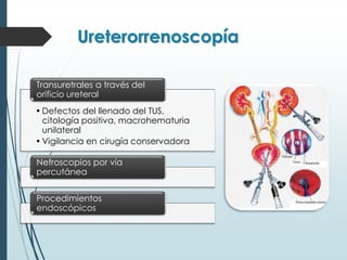 Ureterorrenoscopía
•Defectos del llenado del TUS,
citología positiva, macrohematuria
unilateral
•Vigilancia en cirugía conservadora
Transuretrales a través del
orificio ureteral
Nefroscopios por vía
percutánea
Procedimientos
endoscópicos
 