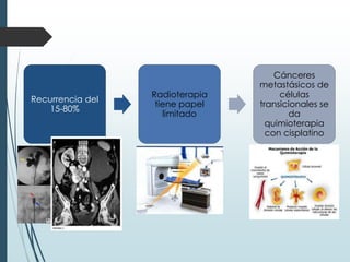 Recurrencia del
15-80%
Radioterapia
tiene papel
limitado
Cánceres
metastásicos de
células
transicionales se
da
quimioterapia
con cisplatino
 