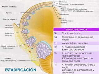 ESTADIO DEL TUMOR
Tis Carcinoma in situ
Ta Carcinoma en la mucosa, no
invasor
T1 Invade tejido conectivo
T2 A: musculo superficial
B: musculo profundo
T3 A: invasión microscópica de
tejido perivesical
B: invasión macroscópica de
tejido perivesical
T4 A: invasión de próstata, útero y
vagina
B: invasión de pared pélvica y
abdominal
ESTADIFICACIÓN
 