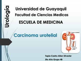 Urología
Tapia Castro Allan Silvester
5to Año Grupo 4B
Universidad de Guayaquil
Facultad de Ciencias Medicas
ESCUELA DE MEDICINA
Carcinoma urotelial
 