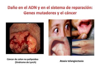 Cáncer de colon no polipoideo
(Síndrome de Lynch) Ataxia telangiectasia
 