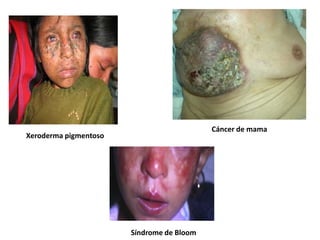 Xeroderma pigmentoso
Síndrome de Bloom
Cáncer de mama
 