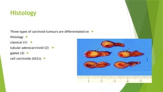 carcinoid.pptx presentation carcinoid tumor | PPTX