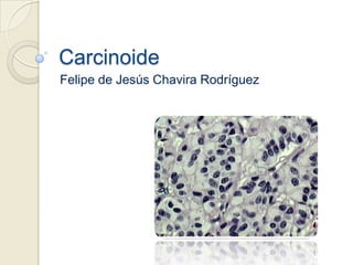Carcinoide
Felipe de Jesús Chavira Rodríguez
 