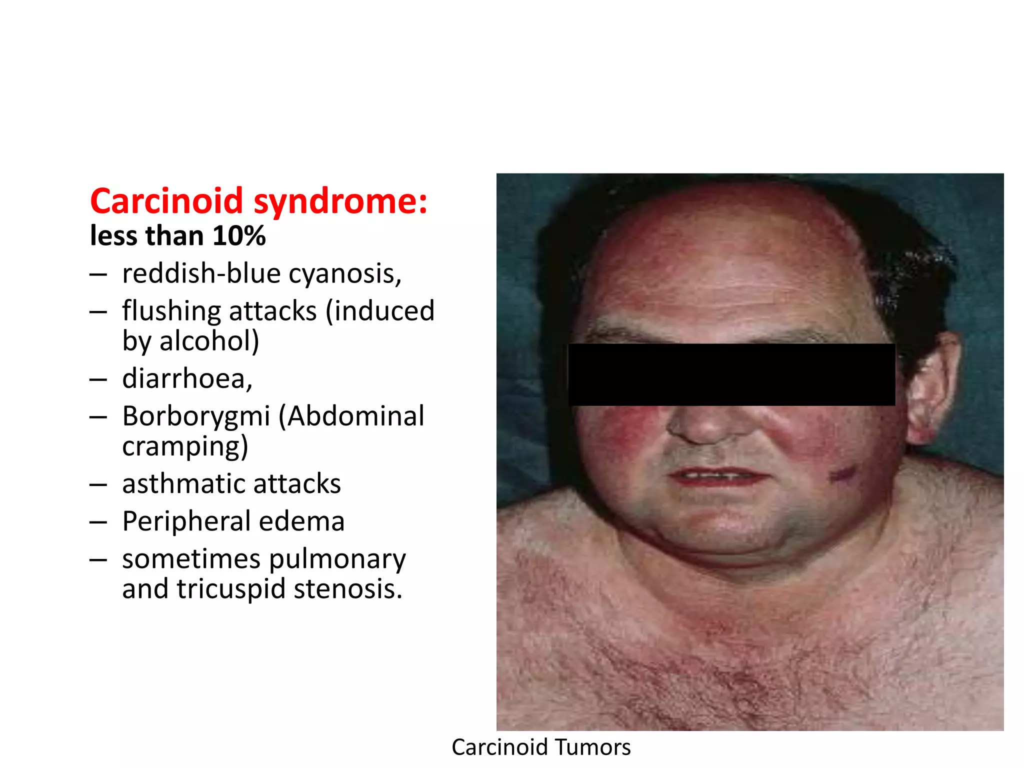 Carcinoid syndrome:
less than 10%
– reddish-blue cyanosis,
– flushing attacks (induced
   by alcohol)
– diarrhoea,
– Borborygmi (Abdominal
   cramping)
– asthmatic attacks
– Peripheral edema
– sometimes pulmonary
   and tricuspid stenosis.




                              Carcinoid Tumors
 