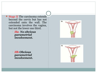  Stage II The carcinoma extends
beyond the cervix but has not
extended onto the wall. The
carcinoma involves the vagina,
but not the lower one third.
 IIa No obvious
parametrial
involvement.
 IIb Obvious
parametrial
involvement.
 