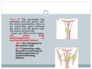  Stage III The carcinoma has
extended onto the pelvic wall.
On rectal examination, there is
no cancer-free space between
the tumor and the pelvic wall.
The tumor involves the
lower one third of the vagina.
All cases with
hydronephrosis or
nonfunctioning kidney.
 III a No extension to
the pelvic wall.
 III b Extension onto
the pelvic wall and/or
hydronephrosis or
nonfunctioning
kidney.
 
