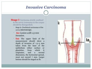 Invasive Carcinoma
Stage I Carcinoma strictly confined
to the cervix (extension to the corpus
should be disregarded).
 Stage Ia Preclinical carcinomas of the
cervix microscopy.
 Ia1 Lesion with ≤3 mm
invasion.
 Ia2 The upper limit of the
measurement should show a
depth of invasion of >3–5 mm
taken from the base of the
epithelium either surface or
glandular, from which it
originates, and a second
dimension, the horizontal spread,
must not exceed 7 mm. Larger
lesions should be staged as Ib.
 