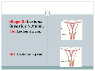  Stage Ib Lesions
invasive > 5 mm.
 Ib1 Lesion ≤4 cm.
 Ib2 Lesions >4 cm.
 